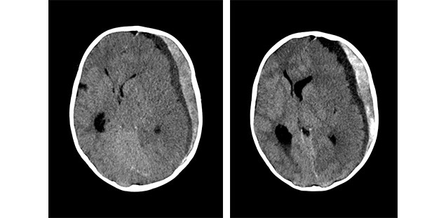 Auf diesem Bild sehen Sie zwei CT-Aufnahmen, auf denen eine schwere einseitige Blutung sichtbar ist, bei der das darunterliegende Gehirn verdrängt wurde