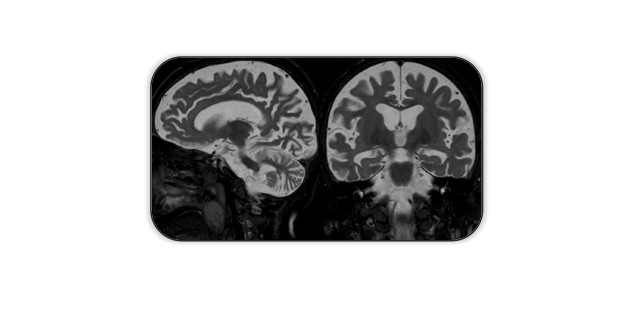 MRT-Aufnahme des kindlichen Gehirns mit dreieinhalb Jahren: Die grauen Bereiche zeigen die Hirnsubstanz