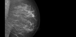 Mammographieaufnahme