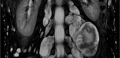 1.	Coronare T2-gewichtete Aufnahme der Lendenwirbelsäule und des Beckens eines Patienten mit Neurofibromatose Typ 1 und Ausbildung multipler peripherer Nervenscheidentumore. Diese stellen sich als T2 hyperintense, ovaläre Strukturen mit paraspinaler Betonung dar.