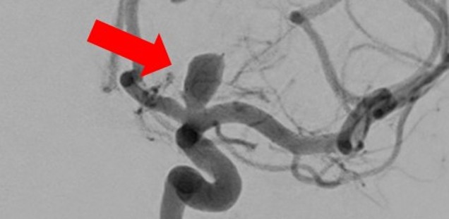 Aneurysma an der Aufzweigung der linken intrakraniellen Arteria carotis interna 