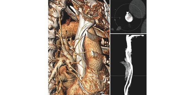 Präoperative Diagnostik vor der Sondenextraktion (3D CT)