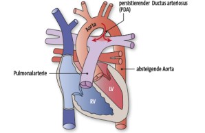 PDA | Persistierender Ductus arteriosus